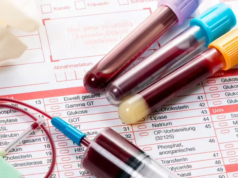 انواع آزمایش خون کدامند؟